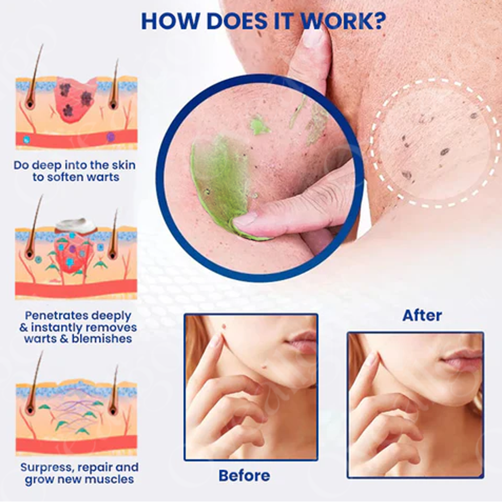 ✅ Official Store: Lovilds™ PRO NatureErase Instant Mole & Spot Removal Gel