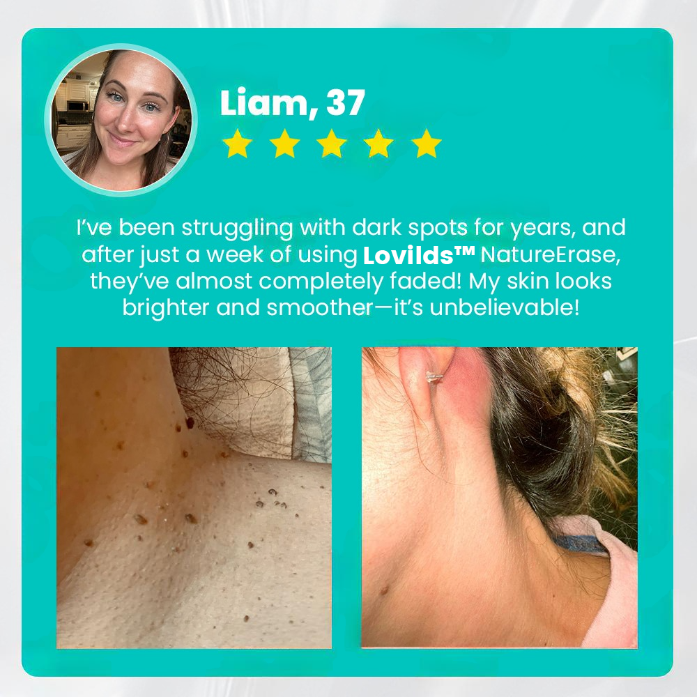 ✅ Official Store: Lovilds™ PRO NatureErase Instant Mole & Spot Removal Gel